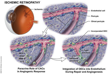 retinopathy-revascularization
