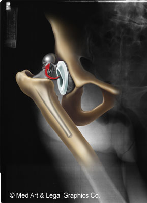 Prosthetic Hip Dislocated